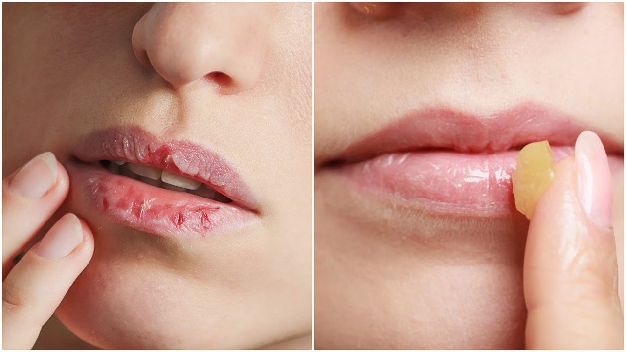 chapped, dry lips? The following are easy home cures for this threat.