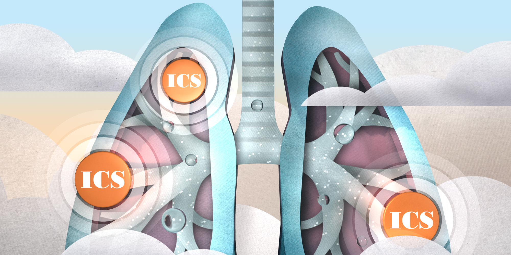 Inhaled Corticosteroids: A Comprehensive Guide